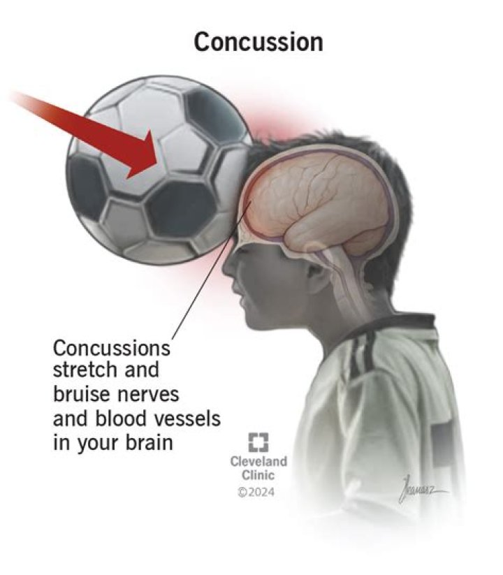 What is the #1 most concussed sport?