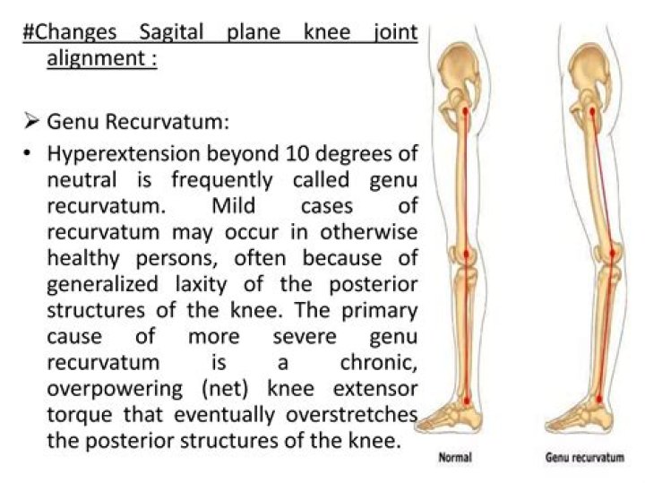 What is the best choice for genu Recurvatum?