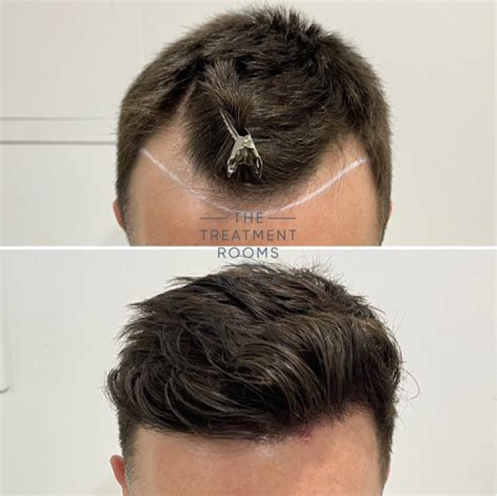 What is the best hair restoration?