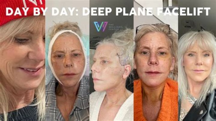 What is the best procedure for a face lift?