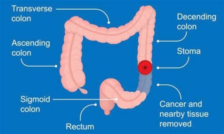 What is the best surgical option for the resection of transverse colon cancer?