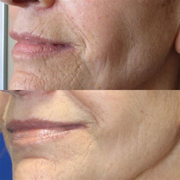 What is the best treatment for decolletage wrinkles?