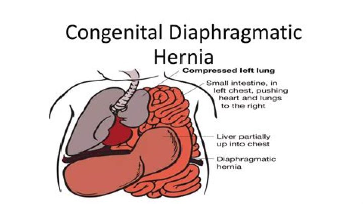 What is the cause of congenital diaphragmatic hernia?