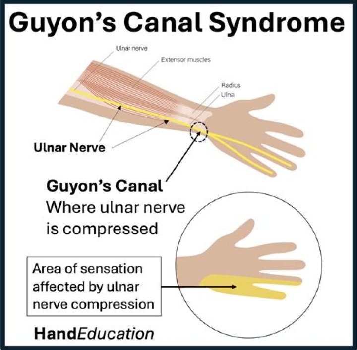 What is the CPT code for Guyon canal release?