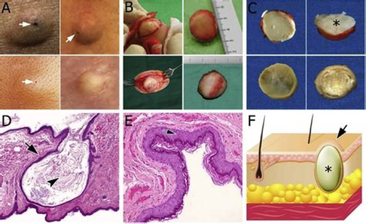 What is the difference between epidermoid and adenocarcinoma cancer?