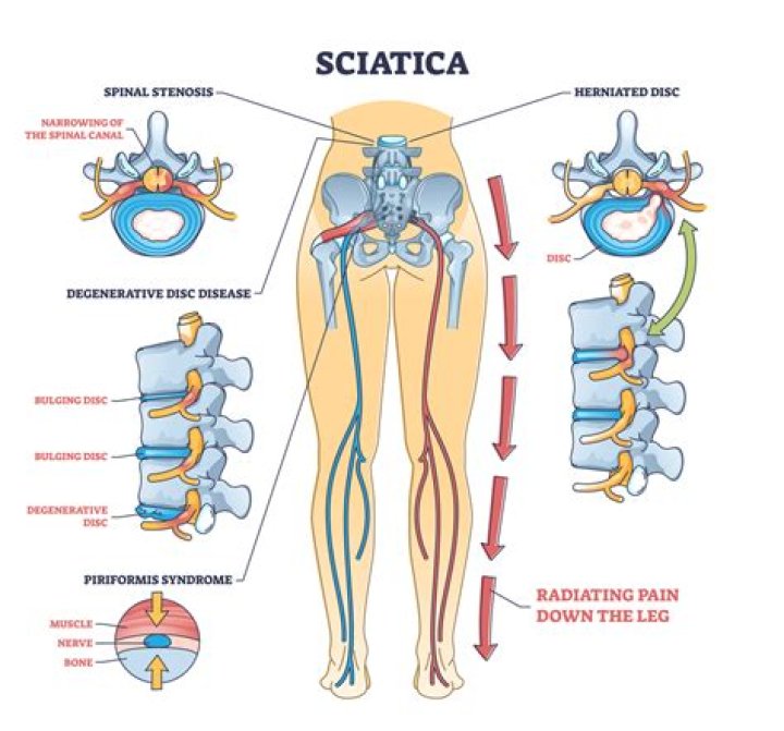 What is the difference between sciatica and femoral nerve pain?