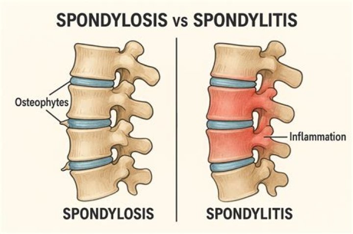 What is the difference between spondylitis and spondyloarthritis?