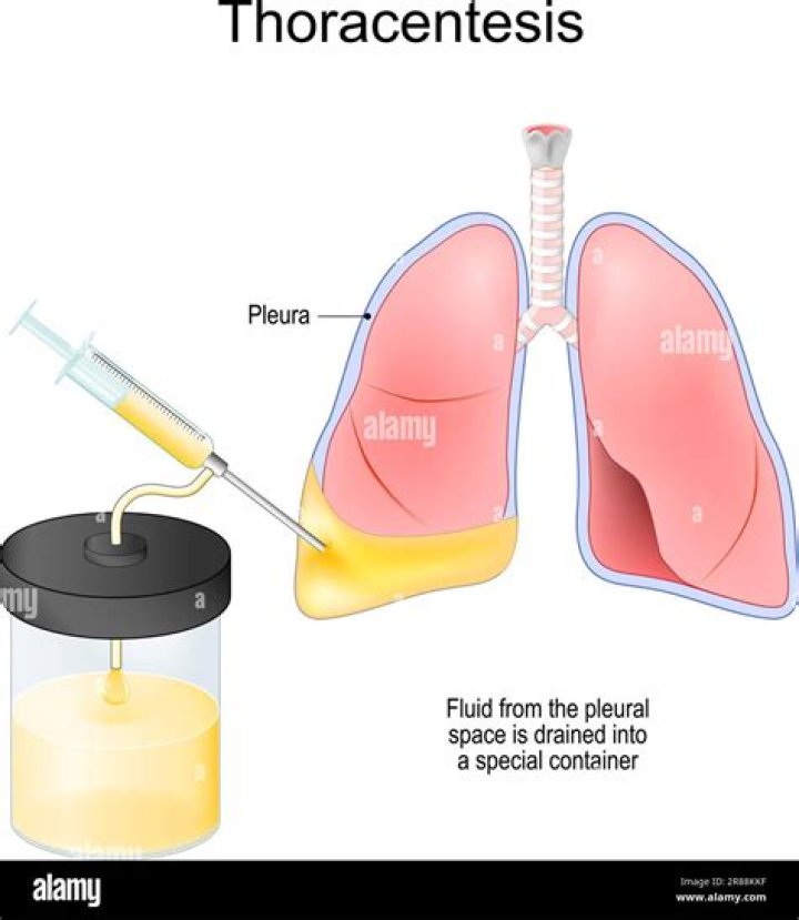 What is the difference between Thoracocentesis and thoracentesis?