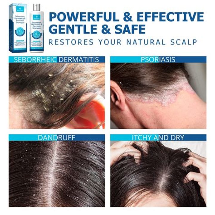 What is the healthiest shampoo for dry scalp?