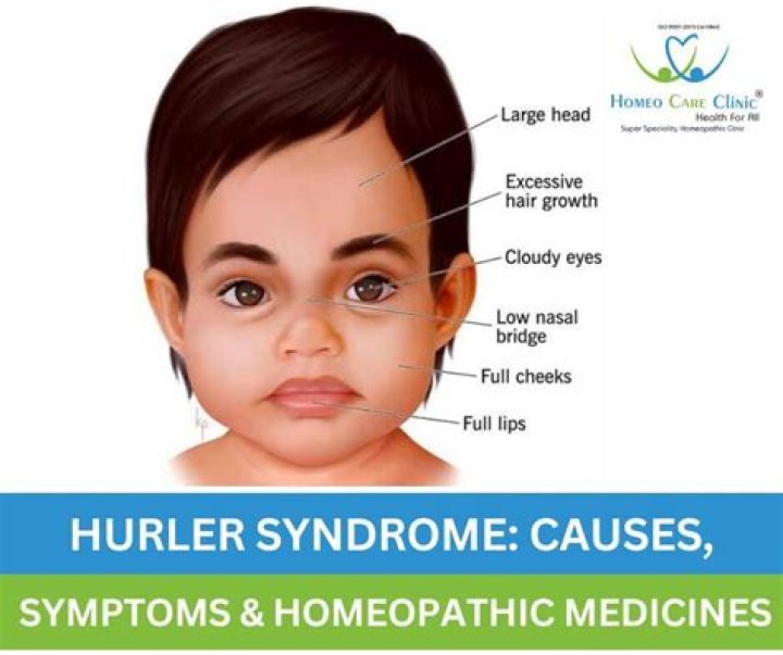 What is the Hurler syndrome?