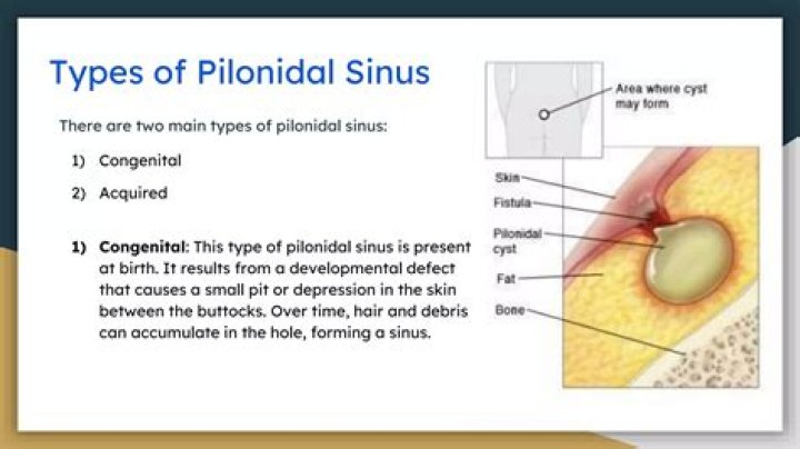 What is the main cause of pilonidal sinus?