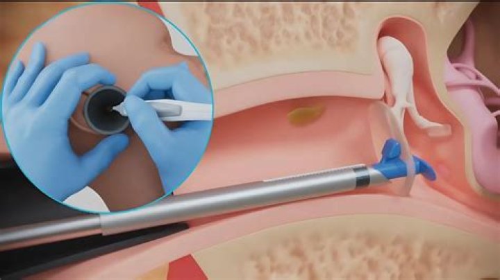 What is the medical term for ear tube surgery?