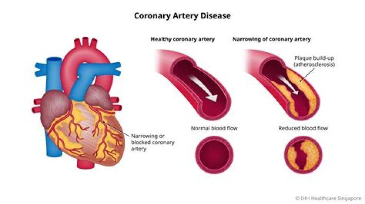 What is the most common cause of coronary artery abnormalities?