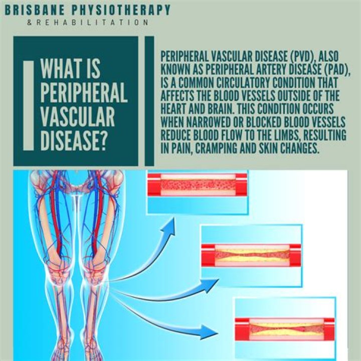What is the most common type of peripheral vascular disease?