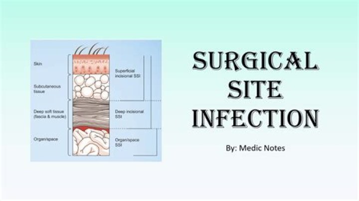 What is the most common type of surgical site infection?