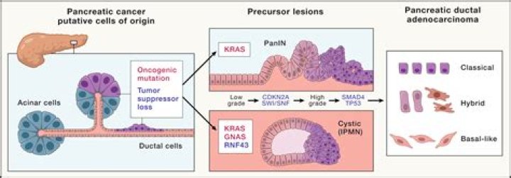 What is the pathophysiology of pancreatic cancer?