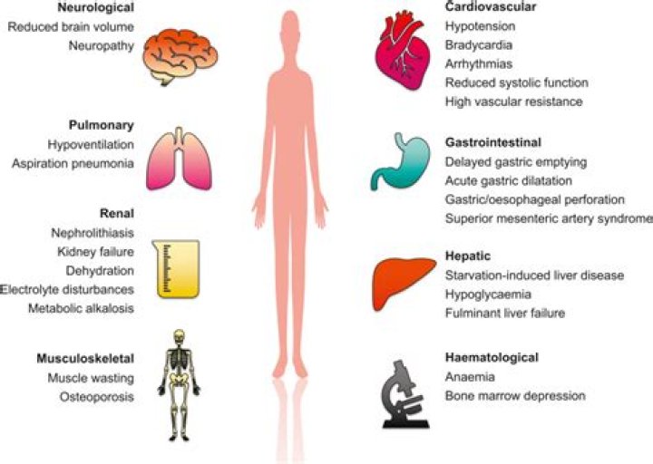 What is the peak age for onset of anorexia nervosa?