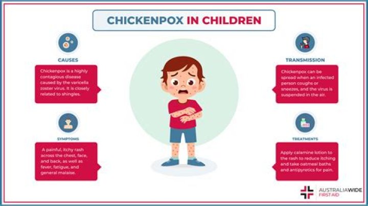 What is the prevention and treatment of chickenpox?
