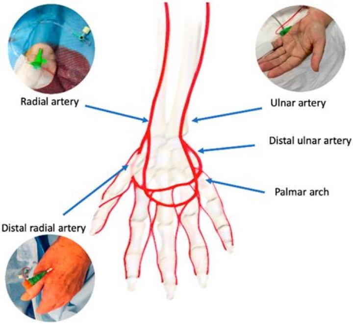 What is the radial artery to the ulnar artery?