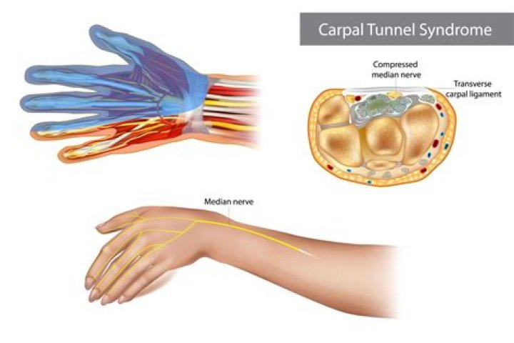 What is the special test for carpal tunnel syndrome?