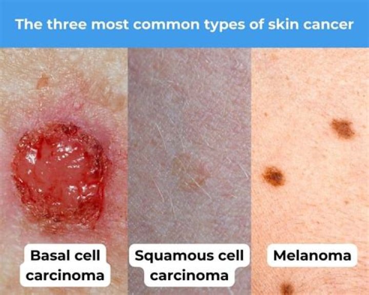 What is Type 3 skin cancer?