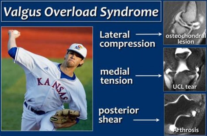 What is valgus extension Overload?