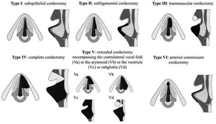 What is vocal cord Cordotomy?