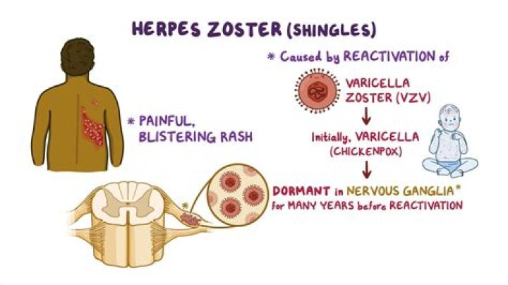 What is zoster myelitis?