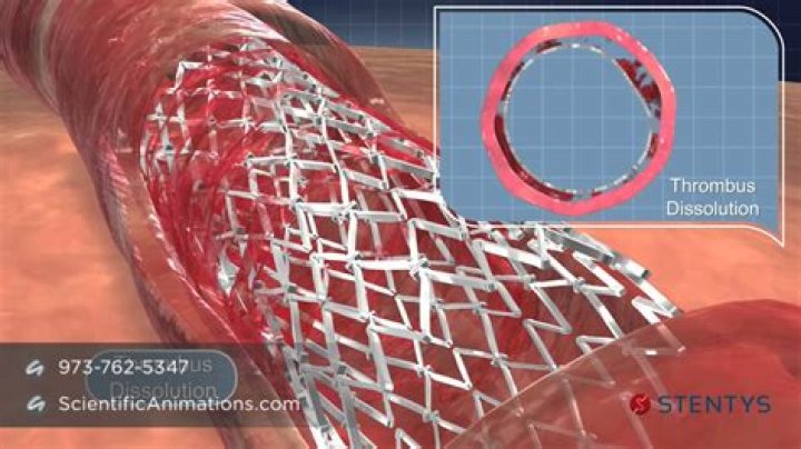 What material is stent made of?