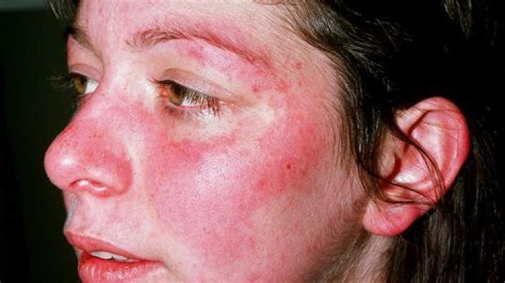 What mimics butterfly rash?