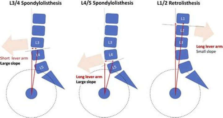 What nerves are at L2 L3?