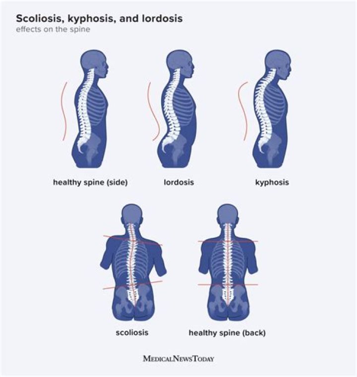What pain does kyphosis cause?