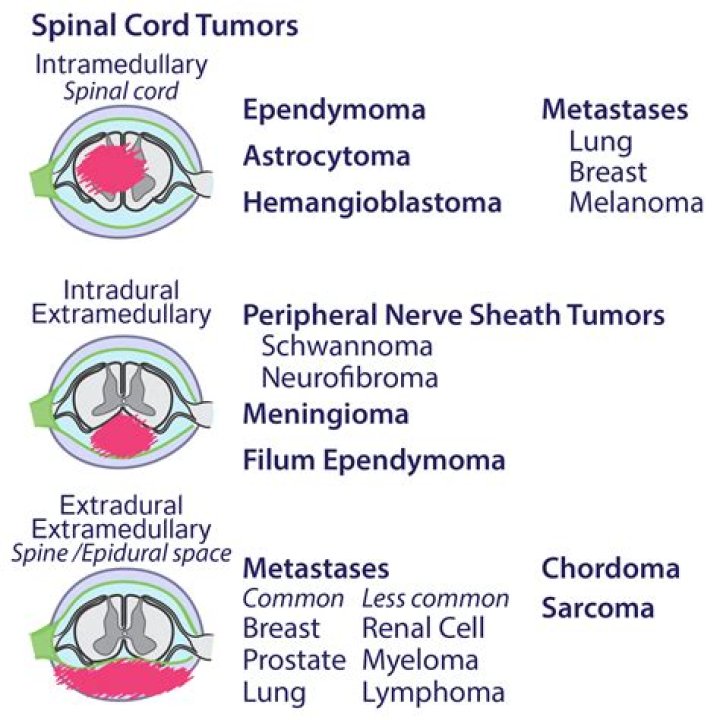 What percent of spinal tumors are cancerous?