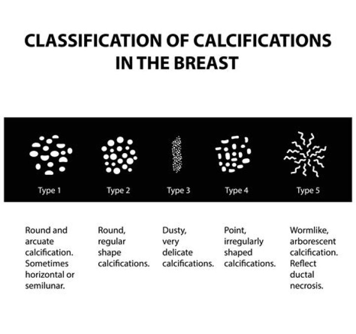 What percentage of indeterminate calcifications are malignant?