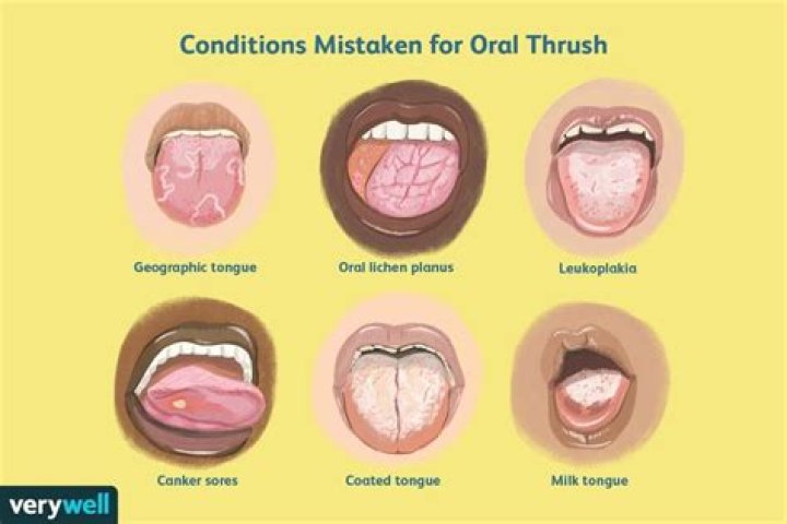 What STD can you get around your mouth?