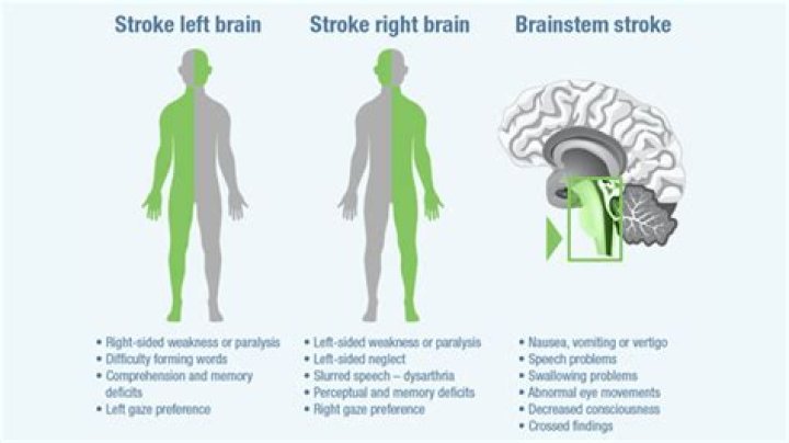What type of stroke causes left neglect?