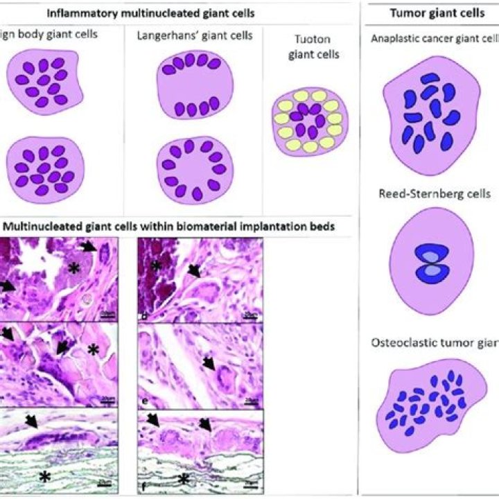 What virus causes multinucleated giant cells?