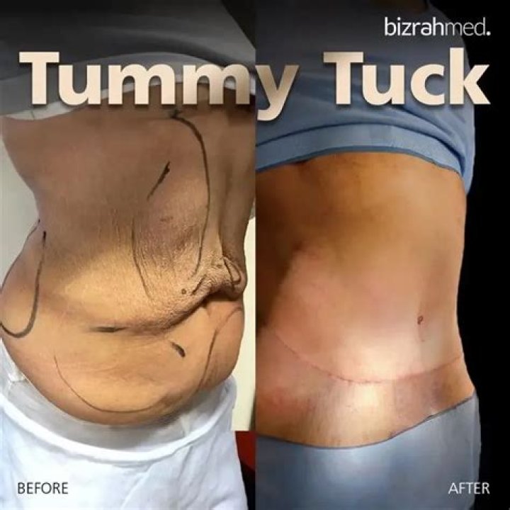 When can I tie my tummy after c-section?
