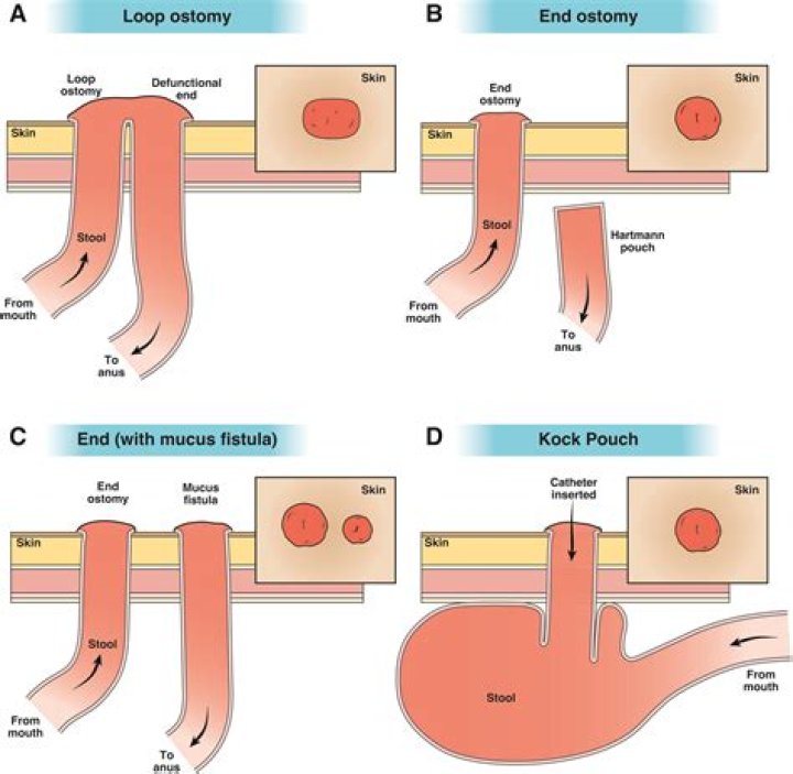 When did colostomy surgery start?