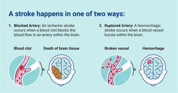 When does a hemorrhagic stroke need surgery?