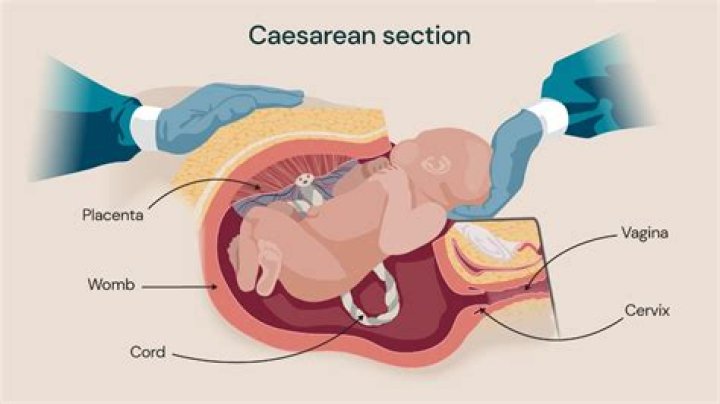 When does C-section heal internally?