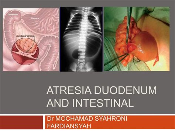 When does duodenal atresia develop?