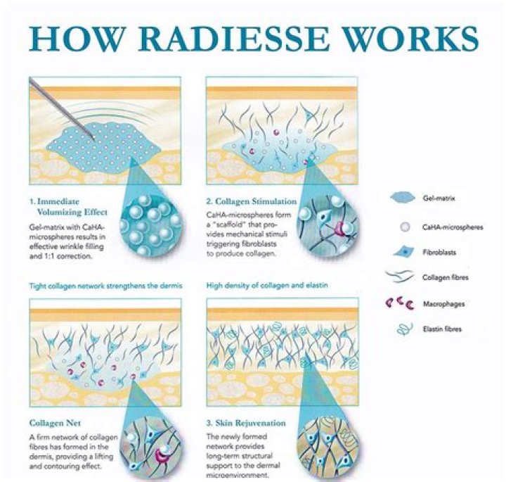When does Radiesse stimulate collagen?