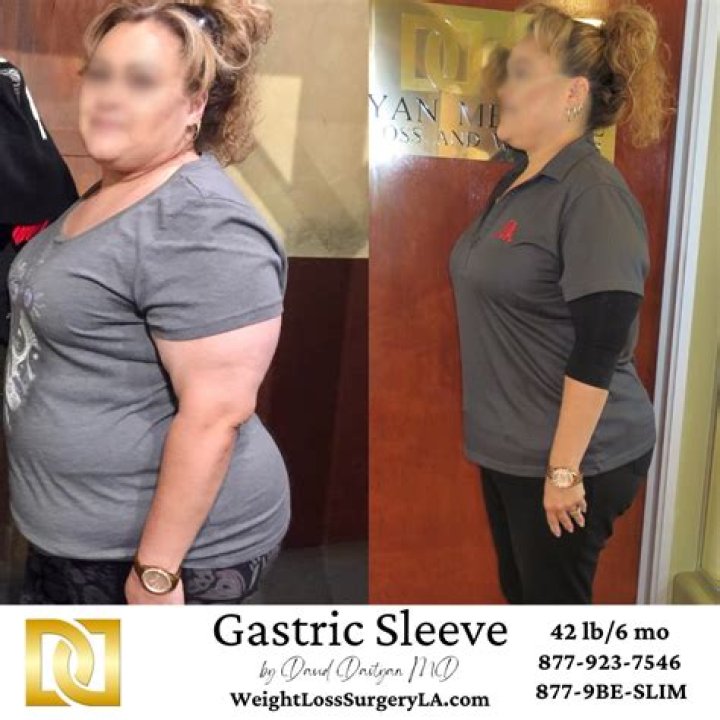 When does weight loss slow down after gastric sleeve?
