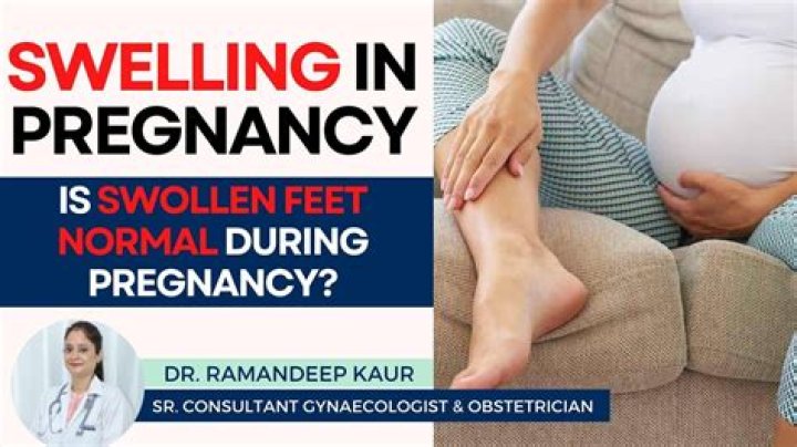 When should I be worried about swelling during pregnancy?