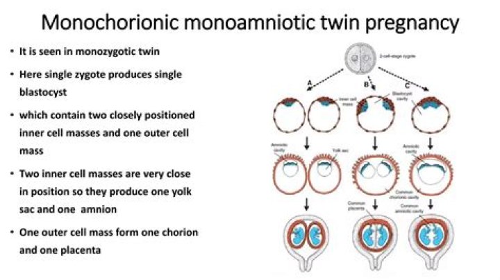 When should monochorionic monoamniotic twins be delivered?