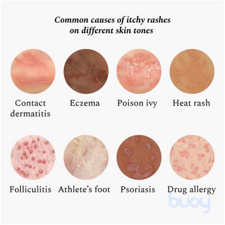 Where does it itch when you have HIV?