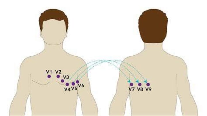 Where does V7 V8 V9 go?