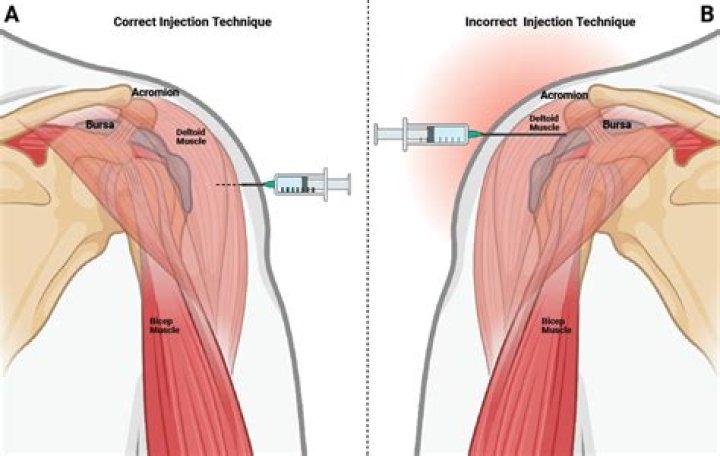 Where should ceftriaxone be injected?