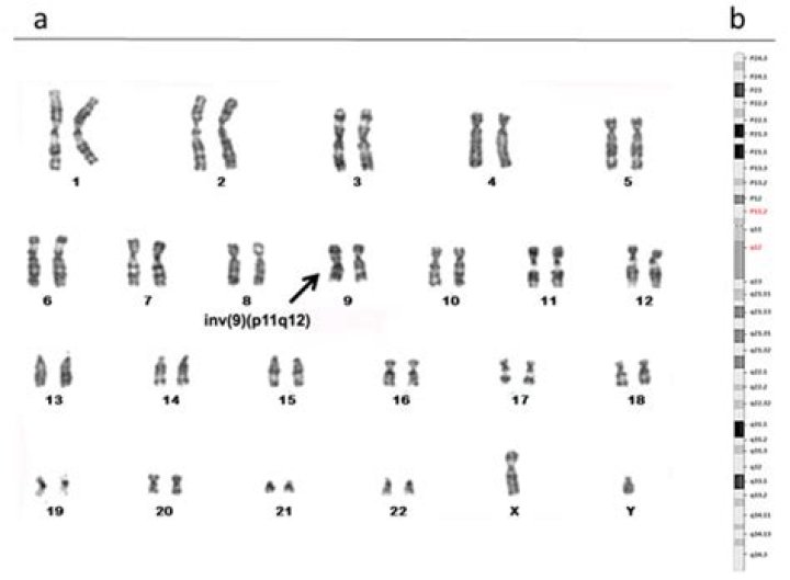 Which arm of chromosome 17 is implicated in this syndrome?